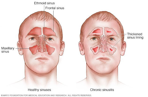 mcdc7_chronic_sinusitis-8col